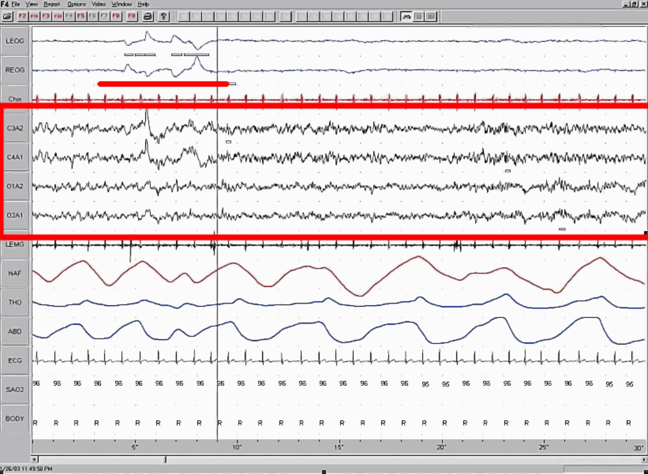 A typical night's hypnogram. REM episodes lengthen as the night progresses; the last REM episode is typically when the most vivid dreams occur.